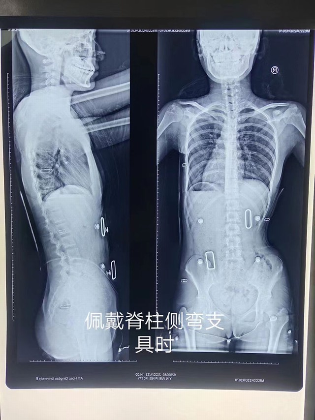康复实例